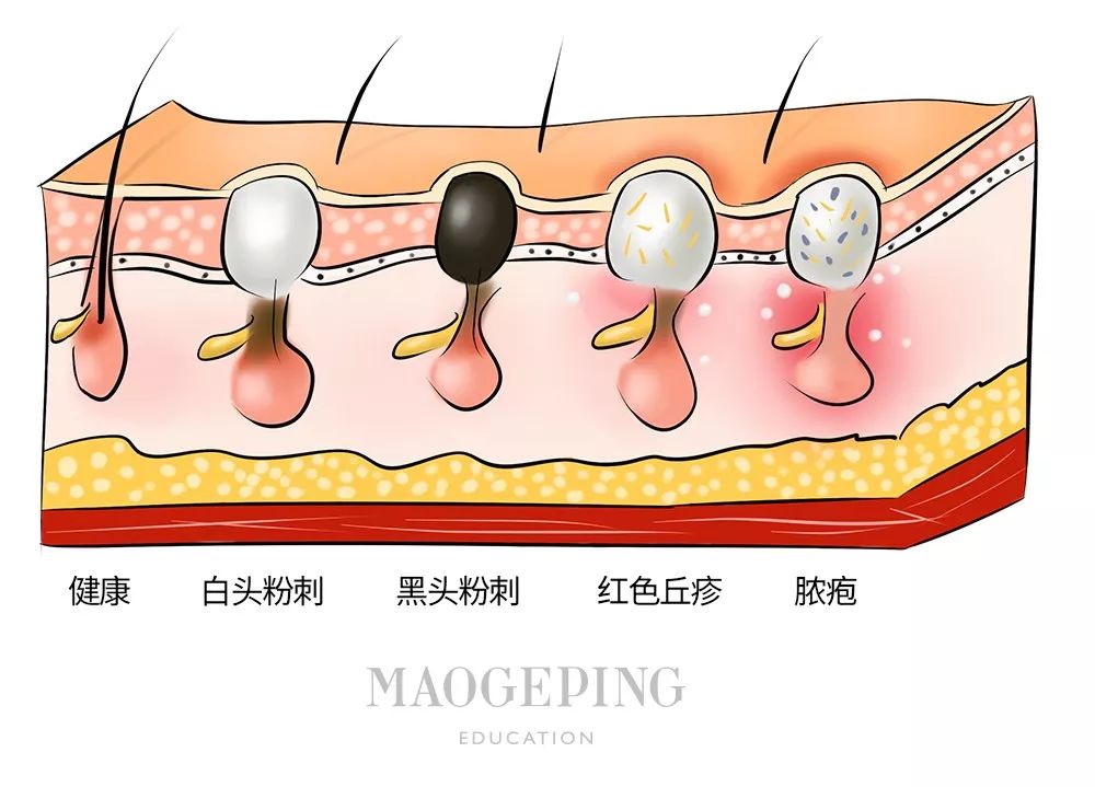 全网最火的4种去黑头方法千万别试